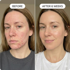 PDRN Micro-Infusion Skin Booster