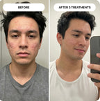 PDRN Micro-Infusion Skin Booster