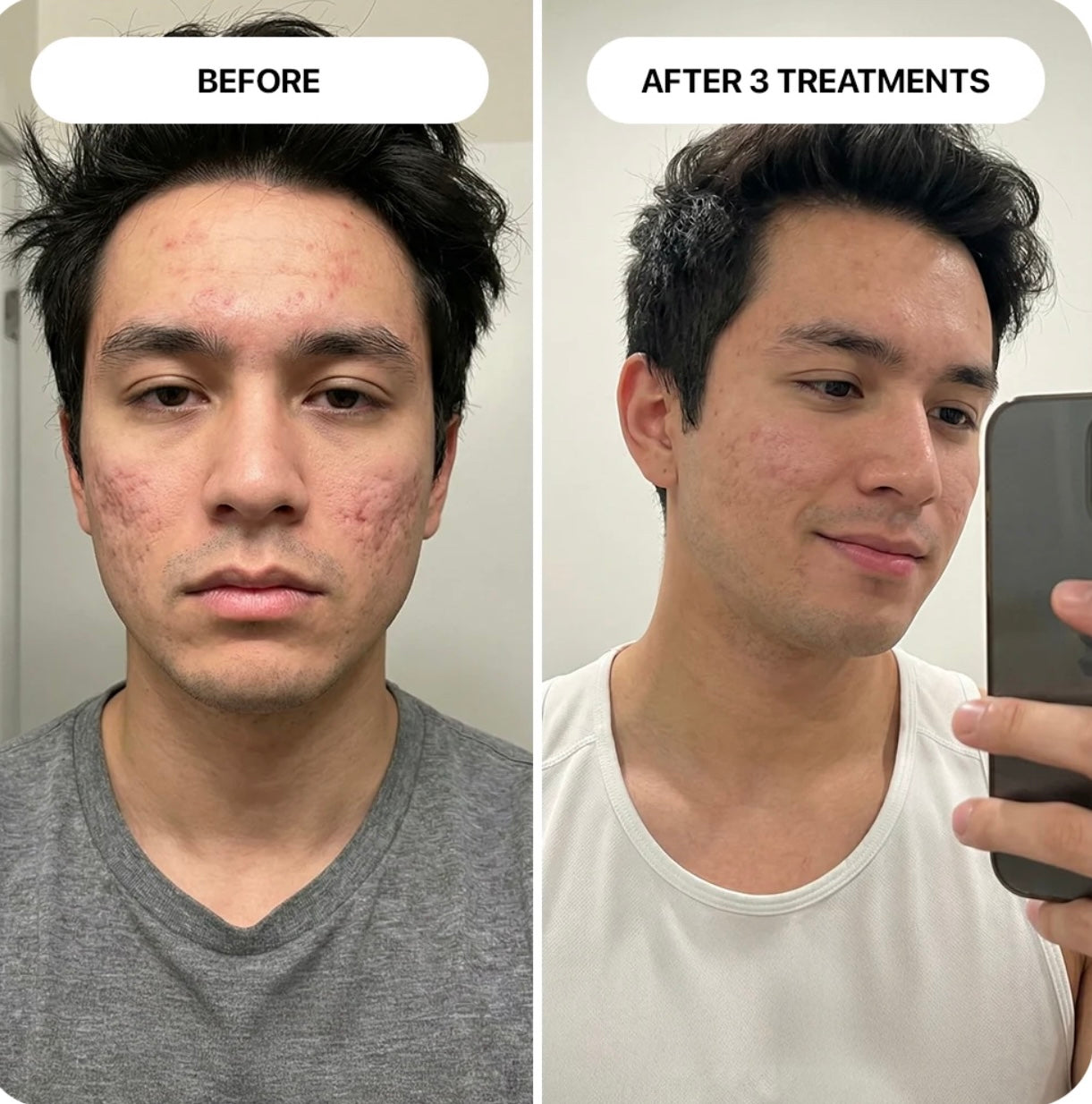 PDRN Micro-Infusion Skin Booster