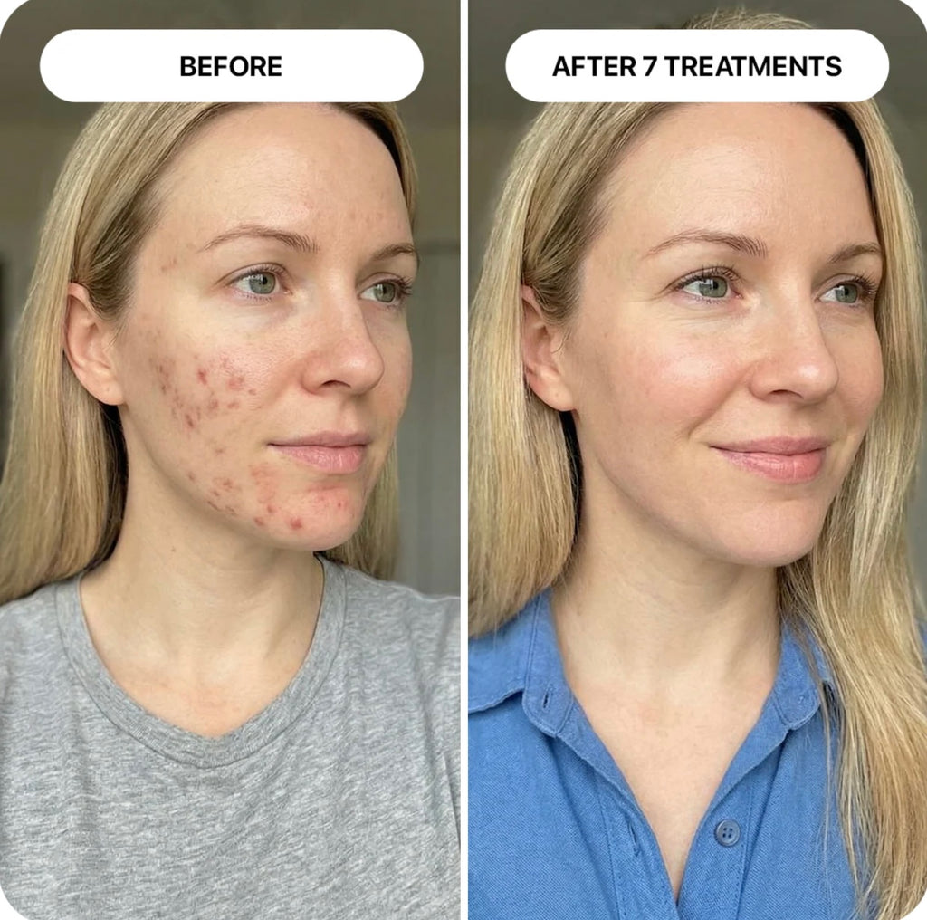 PDRN Micro-Infusion Skin Booster