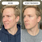 PDRN Micro-Infusion Skin Booster