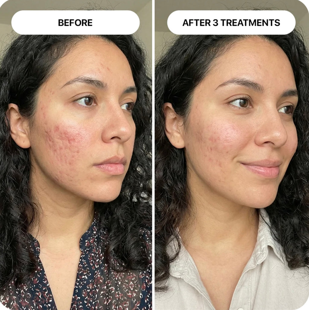 PDRN Micro-Infusion Skin Booster