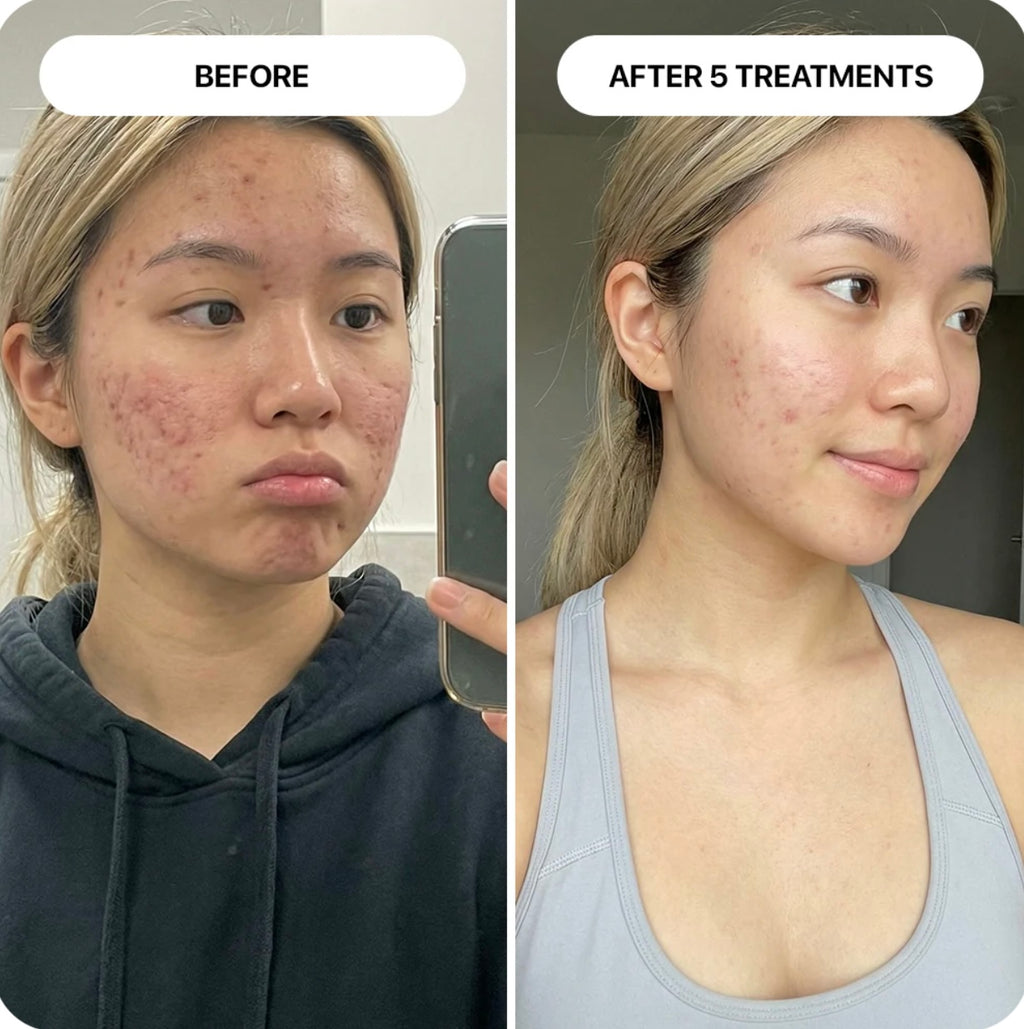 PDRN Micro-Infusion Skin Booster