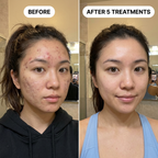 PDRN Micro-Infusion Skin Booster