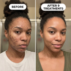 PDRN Micro-Infusion Skin Booster