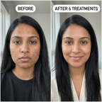 PDRN Micro-Infusion Skin Booster