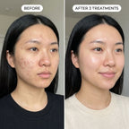 PDRN Micro-Infusion Skin Booster